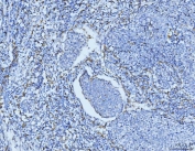 IHC staining of FFPE human lung cancer tissue with CD163 antibody at 1ug/ml. Required HIER: steam section in pH8 EDTA for 20 min and allow to cool prior to staining.