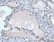 IHC staining of FFPE human rectal cancer tissue with CD163 antibody at 1ug/ml. Required HIER: steam section in pH8 EDTA for 20 min and allow to cool prior to staining.