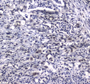 IHC testing of FFPE human rectal cancer tissue with GFI1 antibody at 1ug/ml. Required HIER: steam section in pH6 citrate buffer for 20 min and allow to cool prior to staining.