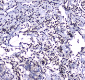 IHC testing of FFPE human breast cancer tissue with GFI1 antibody at 1ug/ml. Required HIER: steam section in pH6 citrate buffer for 20 min and allow to cool prior to staining.