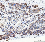 IHC testing of FFPE human esophageal squamous carcinoma tissue with M6PR antibody. Required HIER: steam section in pH8 EDTA buffer for 20 min and allow to cool prior to staining.