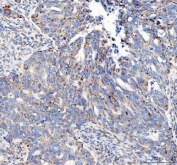 IHC testing of FFPE human ovarian cancer tissue with M6PR antibody. Required HIER: steam section in pH8 EDTA buffer for 20 min and allow to cool prior to staining.
