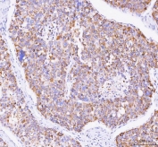 IHC testing of FFPE human liver cancer tissue with M6PR antibody. Required HIER: steam section in pH8 EDTA buffer for 20 min and allow to cool prior to staining.