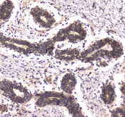 IHC testing of FFPE human breast cancer tissue with POLR2A antibody. HIER: boil tissue sections in pH6, 10mM citrate buffer, for 10-20 min followed by cooling at RT for 20 min.