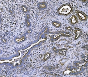 IHC testing of FFPE human gallbladder adenocarcinoma tissue with CLPP antibody. HIER: boil tissue sections in pH8 EDTA for 20 min and allow to cool before testing.