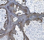 IHC testing of FFPE human ovarian cancer tissue with CLPP antibody. HIER: boil tissue sections in pH8 EDTA for 20 min and allow to cool before testing.