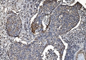 IHC testing of FFPE human breast cancer tissue with CLPP antibody. HIER: boil tissue sections in pH8 EDTA for 20 min and allow to cool before testing.