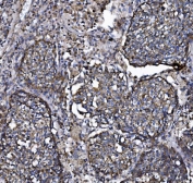 IHC testing of FFPE human lung cancer tissue with CLPP antibody. HIER: boil tissue sections in pH8 EDTA for 20 min and allow to cool before testing.