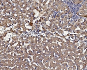 IHC testing of FFPE human liver cancer tissue with CLPP antibody. HIER: boil tissue sections in pH8 EDTA for 20 min and allow to cool before testing.