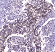 IHC testing of FFPE human lung cancer tissue with CLPP antibody. HIER: steam section in pH6 citrate buffer for 20 min and allow to cool prior to staining.