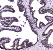 IHC testing of FFPE human prostate cancer tissue with WWOX antibody at 1ug/ml. Required HIER: steam section in pH6 citrate buffer for 20 min and allow to cool prior to staining.