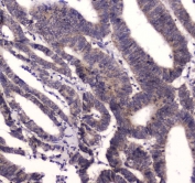 IHC testing of FFPE human colon cancer tissue with BRD7 antibody at 1ug/ml. Required HIER: steam section in pH6 citrate buffer for 20 min and allow to cool prior to staining.