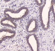 IHC testing of FFPE human breast cancer tissue with IDE antibody at 1ug/ml. Required HIER: steam section in pH6 citrate buffer for 20 min and allow to cool prior to staining.