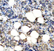 Immunohistochemical staining of FFPE human breast cancer tissue with STAT2 antibody, HRP-secondary and DAB substrate. HIER: boil tissue sections in pH8 EDTA for 20 min and allow to cool before testing.