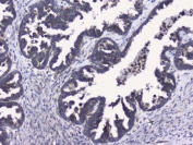 IHC staining of FFPE human ovarian cancer with RALBP1 antibody. HIER: boil tissue sections in pH6, 10mM citrate buffer, for 20 min and allow to cool before testing.