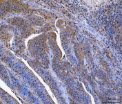 IHC staining of FFPE human rectal cancer tissue with Glutathione Reductase antibody. HIER: boil tissue sections in pH8 EDTA for 20 min and allow to cool before testing.