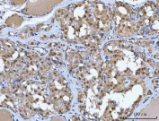 IHC staining of FFPE human thyroid cancer tissue with Glutathione Reductase antibody. HIER: boil tissue sections in pH8 EDTA for 20 min and allow to cool before testing.