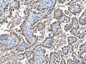 IHC staining of FFPE human lung cancer tissue with Glutathione Reductase antibody. HIER: boil tissue sections in pH8 EDTA for 20 min and allow to cool before testing.
