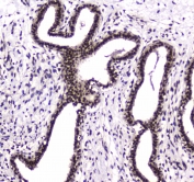 IHC testing of FFPE human breast cancer tissue with PARN antibody at 1ug/ml. Required HIER: steam section in pH6 citrate buffer for 20 min and allow to cool prior to staining.