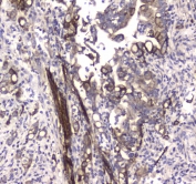 IHC testing of FFPE human colon cancer tissue with LC3A antibody at 1ug/ml. Required HIER: steam section in pH6 citrate buffer for 20 min and allow to cool prior to staining.