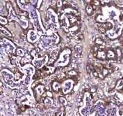 IHC testing of FFPE human colon cancer tissue with GDA antibody at 1ug/ml. Required HIER: steam section in pH6 citrate buffer for 20 min and allow to cool prior to staining.