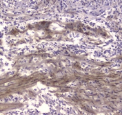 IHC testing of FFPE human colon cancer tissue with CKB antibody at 1ug/ml. Required HIER: steam section in pH6 citrate buffer for 20 min and allow to cool prior to staining.