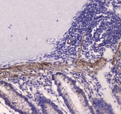 IHC testing of FFPE human rectal cancer tissue with MYLK antibody at 1ug/ml. Required HIER: steam section in pH6 citrate buffer for 20 min and allow to cool prior to staining.