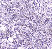 IHC testing of FFPE human lung cancer tissue with Carboxylesterase 1 antibody at 1ug/ml. Required HIER: steam section in pH6 citrate buffer for 20 min and allow to cool prior to staining.