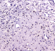 IHC testing of FFPE human breast cancer tissue with RUNX1T1 antibody at 1ug/ml. Required HIER: steam section in pH6 citrate buffer for 20 min and allow to cool prior to staining.
