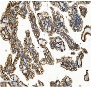 IHC staining of FFPE human renal cancer with VAPB antibody. HIER: boil tissue sections in pH8 EDTA for 20 min and allow to cool before testing.