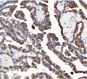 IHC staining of FFPE human renal cancer with VAPB antibody. HIER: boil tissue sections in pH8 EDTA for 20 min and allow to cool before testing.