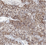 IHC staining of FFPE human liver cancer with VAPB antibody. HIER: boil tissue sections in pH8 EDTA for 20 min and allow to cool before testing.