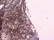 IHC testing of FFPE human liver cancer with RKIP antibody at 1ug/ml. HIER: boil tissue sections in pH6, 10mM citrate buffer, for 10-20 min followed by cooling at RT for 20 min.