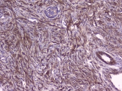 IHC testing of FFPE human pancreatic cancer with RKIP antibody at 1ug/ml. HIER: boil tissue sections in pH6, 10mM citrate buffer, for 10-20 min followed by cooling at RT for 20 min.