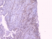 IHC testing of FFPE human intestinal cancer with RKIP antibody at 1ug/ml. HIER: boil tissue sections in pH6, 10mM citrate buffer, for 10-20 min followed by cooling at RT for 20 min.