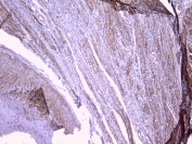 IHC testing of FFPE human endometrial carcinoma with RKIP antibody at 1ug/ml. HIER: boil tissue sections in pH6, 10mM citrate buffer, for 10-20 min followed by cooling at RT for 20 min.