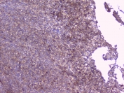 IHC testing of FFPE human sarcoma with RKIP antibody at 1ug/ml. HIER: boil tissue sections in pH6, 10mM citrate buffer, for 10-20 min followed by cooling at RT for 20 min.