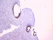 IHC testing of FFPE human breast cancer with RKIP antibody at 1ug/ml. HIER: boil tissue sections in pH6, 10mM citrate buffer, for 10-20 min followed by cooling at RT for 20 min.