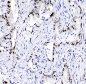 IHC staining of FFPE human intestinal cancer with HNRNPA2B1 antibody. HIER: boil tissue sections in pH8 EDTA for 20 min and allow to cool before testing.