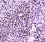 IHC testing of FFPE human intestine cancer tissue with NPC2 antibody at 1ug/ml. Required HIER: steam section in pH6 citrate buffer for 20 min and allow to cool prior to staining.