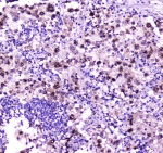 IHC testing of FFPE human lung cancer tissue with NPC2 antibody at 1ug/ml. Required HIER: steam section in pH6 citrate buffer for 20 min and allow to cool prior to staining.