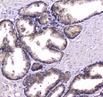 IHC testing of FFPE human prostate cancer tissue with HGD antibody at 1ug/ml. Required HIER: steam section in pH6 citrate buffer for 20 min and allow to cool prior to staining.