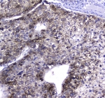 IHC testing of FFPE human liver cancer tissue with HGD antibody at 1ug/ml. Required HIER: steam section in pH6 citrate buffer for 20 min and allow to cool prior to staining.