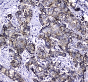 IHC testing of FFPE human breast cancer tissue with LGALS3BP antibody at 1ug/ml. Required HIER: steam section in pH6 citrate buffer for 20 min and allow to cool prior to staining.