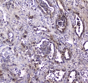 IHC testing of FFPE human intestinal cancer tissue with LGALS3BP antibody at 1ug/ml. Required HIER: steam section in pH6 citrate buffer for 20 min and allow to cool prior to staining.