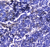 IHC testing of FFPE human lung cancer tissue with LGALS3BP antibody at 1ug/ml. Required HIER: steam section in pH6 citrate buffer for 20 min and allow to cool prior to staining.