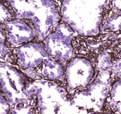 IHC testing of FFPE human lung cancer tissue with Annexin VI antibody at 1ug/ml. Required HIER: steam section in pH6 citrate buffer for 20 min and allow to cool prior to staining.