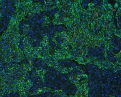 Immunofluorescent staining of FFPE human lung cancer with Annexin VI antibody (green) at 1ug/ml and DAPI nuclear stain (blue). HIER: steam section in pH6 citrate buffer for 20 min.