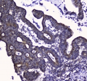 IHC testing of FFPE human intestinal cancer tissue with COX4I1 antibody at 1ug/ml. Required HIER: steam section in pH6 citrate buffer for 20 min and allow to cool prior to staining.