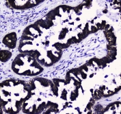 IHC testing of FFPE human thyroid cancer tissue with COX4I1 antibody at 1ug/ml. Required HIER: steam section in pH6 citrate buffer for 20 min and allow to cool prior to staining.